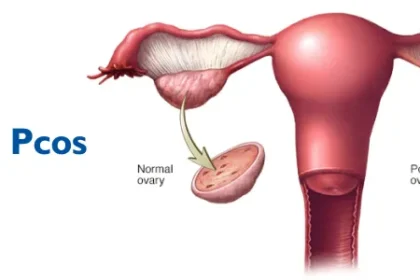 PCOD and PCOS: Are They the Same or Different?