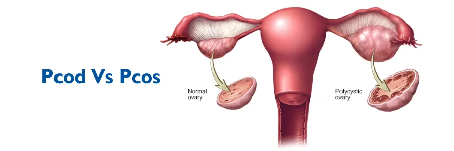 PCOD and PCOS: Are They the Same or Different?